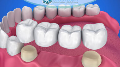 عوارض پروتز و بریج دندان: التهاب لثه، لق شدن، حساسیت و راههای پیشگیری