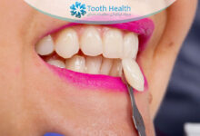 مزایا و معایب روکش موقت دندان پس از عصب کشی