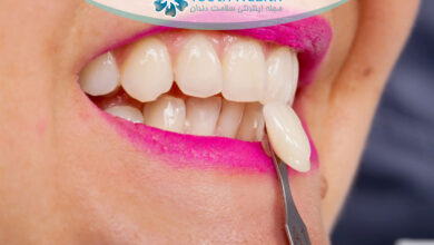 مزایا و معایب روکش موقت دندان پس از عصب کشی