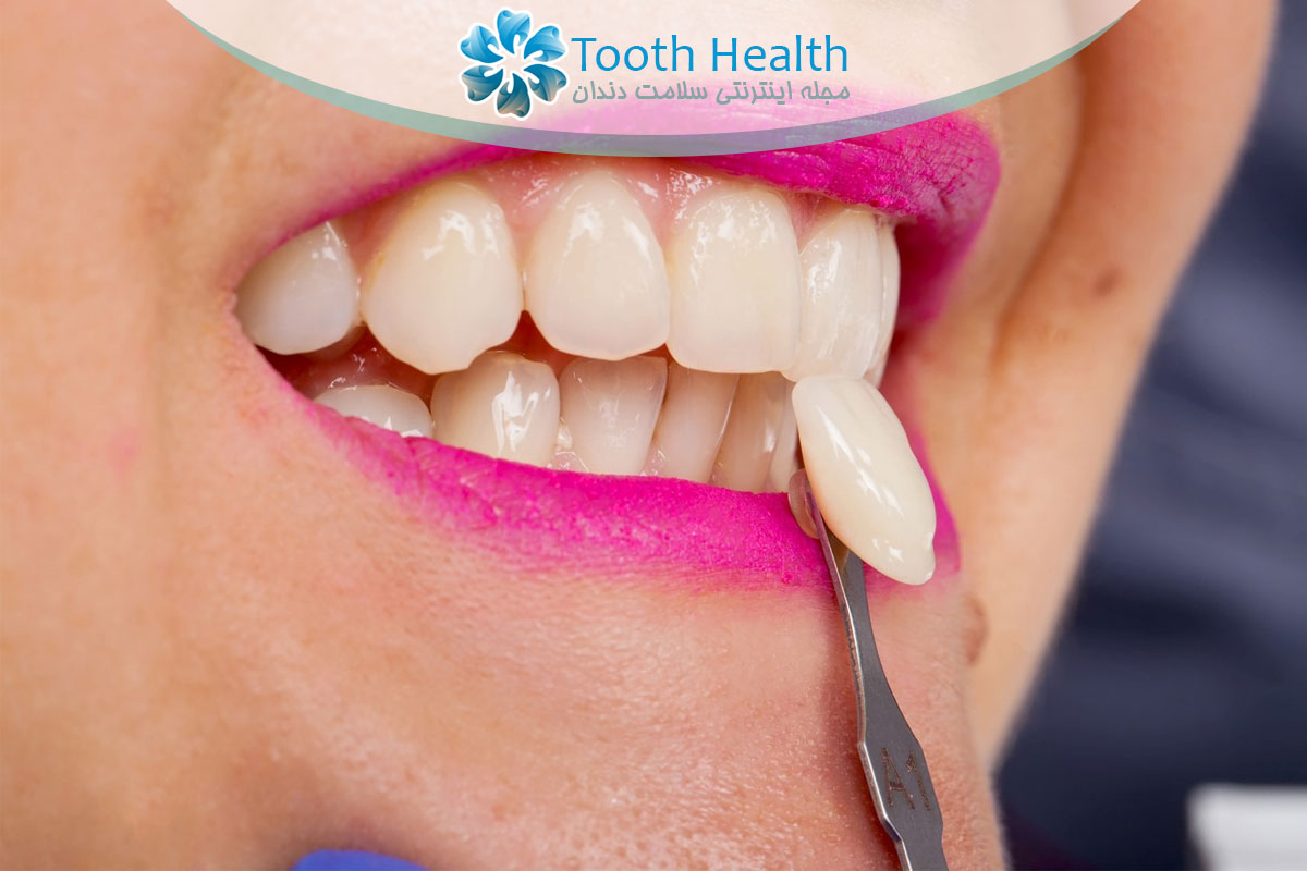 مزایا و معایب روکش موقت دندان پس از عصب کشی