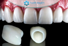 تفاوت روکش زیرکونیا و سرامیک در دندانپزشکی؛ کدام بهتر است؟ راهنمای انتخاب ماندگار و زیباتر برای دندان ها