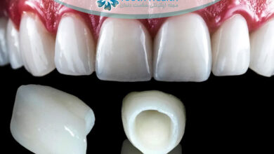 تفاوت روکش زیرکونیا و سرامیک در دندانپزشکی؛ کدام بهتر است؟ راهنمای انتخاب ماندگار و زیباتر برای دندان ها