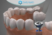 کاهش التهاب پس از جراحی ایمپلنت دندان با 7 راهکار علمی و فوری برای بهبودی سریع