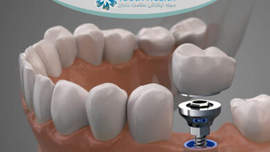 کاهش التهاب پس از جراحی ایمپلنت دندان با 7 راهکار علمی و فوری برای بهبودی سریع