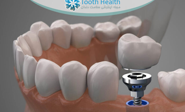 کاهش التهاب پس از جراحی ایمپلنت دندان با 7 راهکار علمی و فوری برای بهبودی سریع