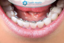 تمرینات مخصوص تقویت عضلات فک در بیماران ارتودنسی