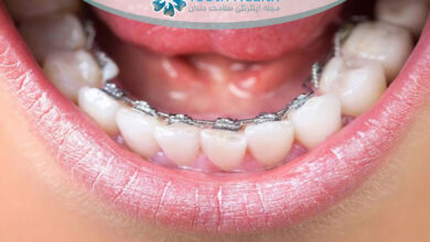 تمرینات مخصوص تقویت عضلات فک در بیماران ارتودنسی