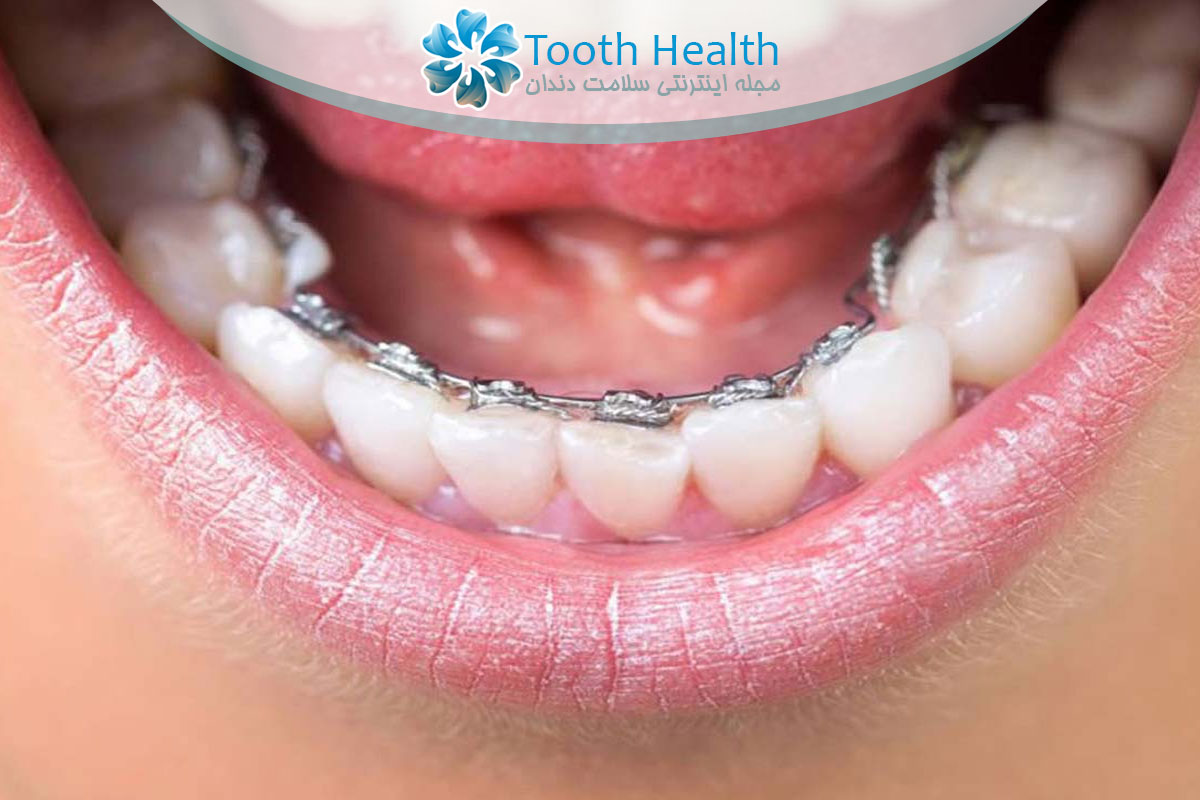 تمرینات مخصوص تقویت عضلات فک در بیماران ارتودنسی