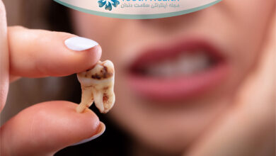 مراقبت از دندان های پوسیده در دوران بارداری؛ نکات طلایی برای پیشگیری از عفونت و حفظ سلامت جنین