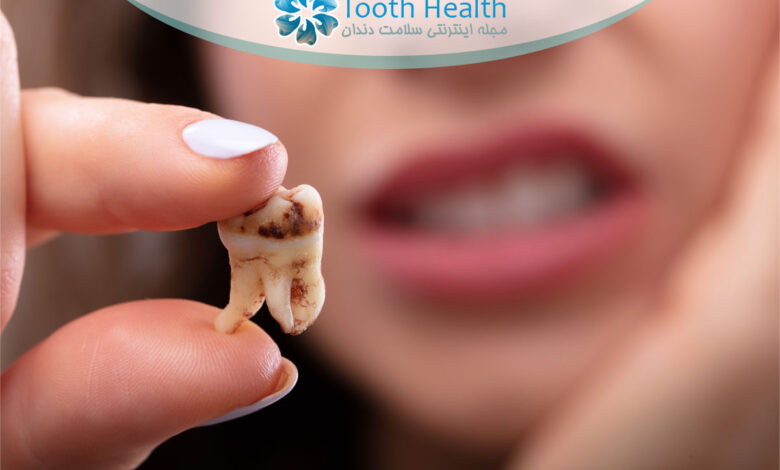 مراقبت از دندان های پوسیده در دوران بارداری؛ نکات طلایی برای پیشگیری از عفونت و حفظ سلامت جنین