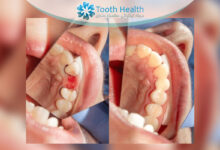 درمان بیماری بریج دندان چگونه انجام می شود؟ راهنمای کامل علائم، علل و بهترین روش های درمان موثر