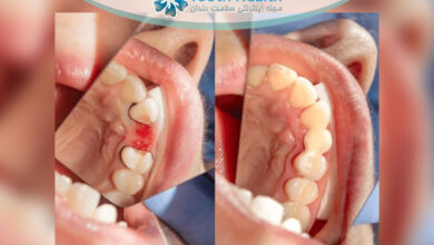 درمان بیماری بریج دندان چگونه انجام می شود؟ راهنمای کامل علائم، علل و بهترین روش های درمان موثر