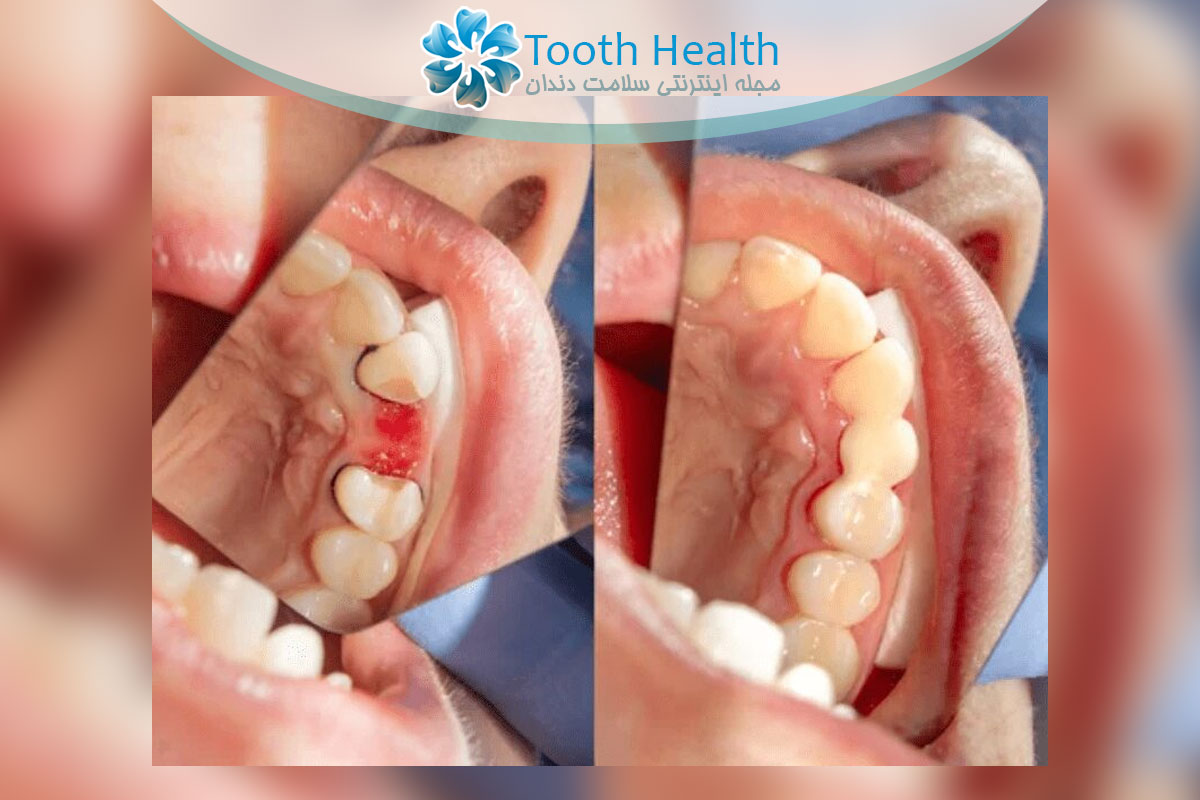 درمان بیماری بریج دندان چگونه انجام می شود؟ راهنمای کامل علائم، علل و بهترین روش های درمان موثر