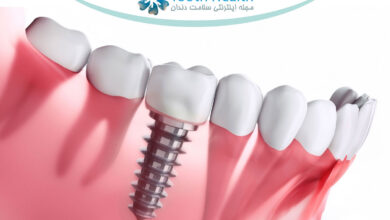هزینه واقعی ایمپلنت دندان در سال ۱۴۰۴؛ راهنمای جامع، شفاف و تخصصی