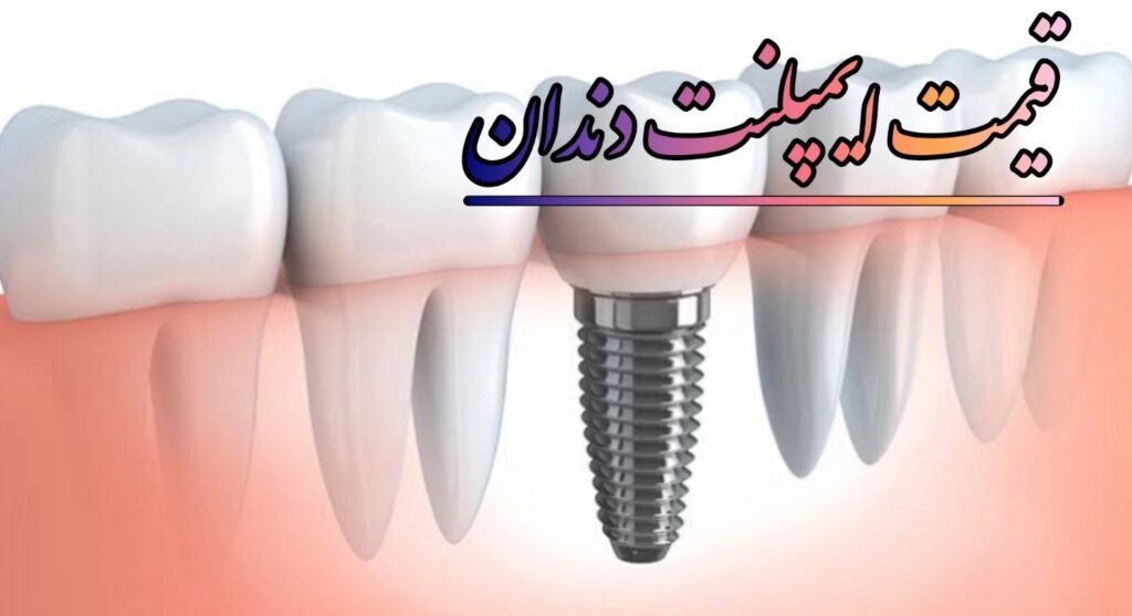 قیمت ایملپنت دندان در تهران 1405