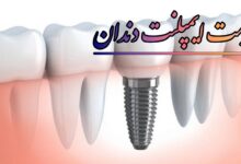 قیمت ایملپنت دندان در تهران 1405