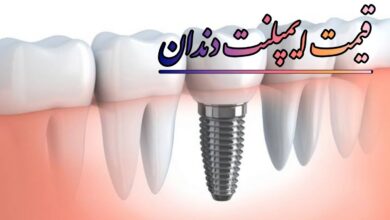 قیمت ایملپنت دندان در تهران 1405