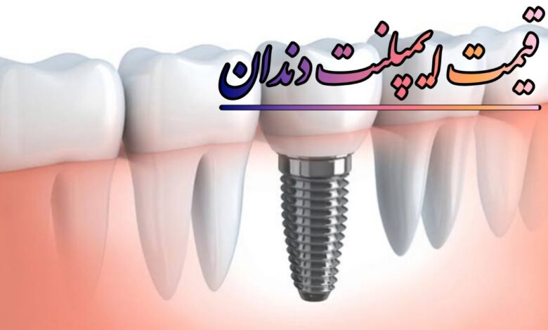 قیمت ایملپنت دندان در تهران 1405