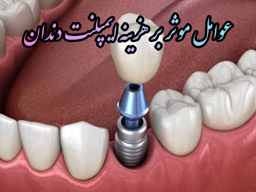 عوامل موثر بر هزینه ایمپلنت دندان