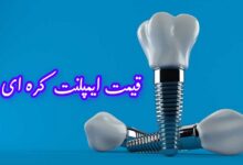 قیمت ایمپلنت کره ای ۱۴۰۵ در تهران