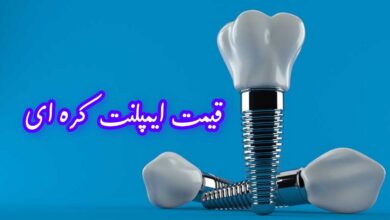 قیمت ایمپلنت کره ای ۱۴۰۵ در تهران