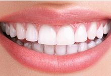 هزینه بلیچینگ دندان در مطب [خدمات بلیچینگ دندان چقدر است + مشاوره]